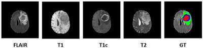 A Novel Approach for Fully Automatic Intra-Tumor Segmentation With 3D U-Net Architecture for Gliomas